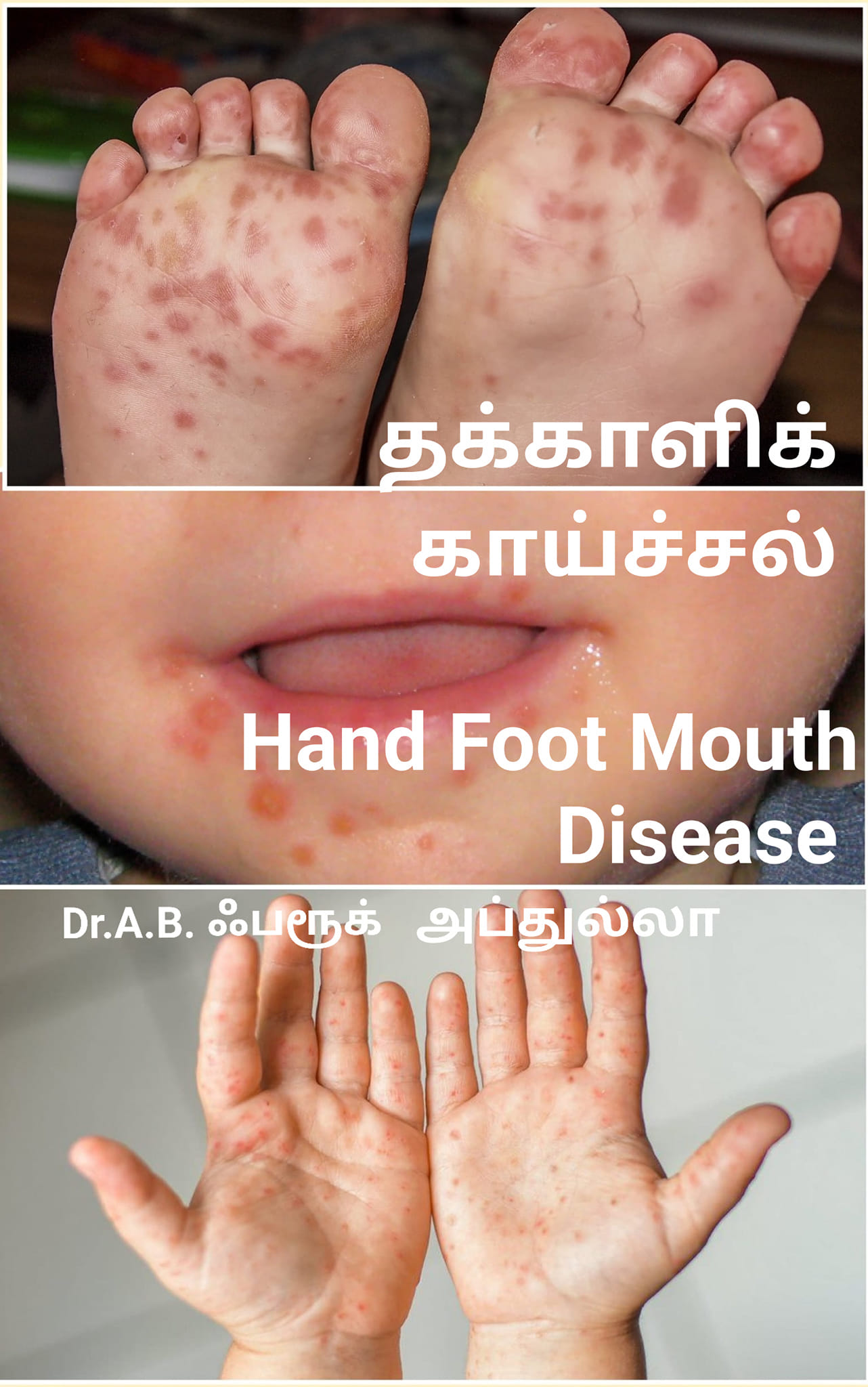 தக்காளி காய்ச்சலால் பீதி தேவையில்லை